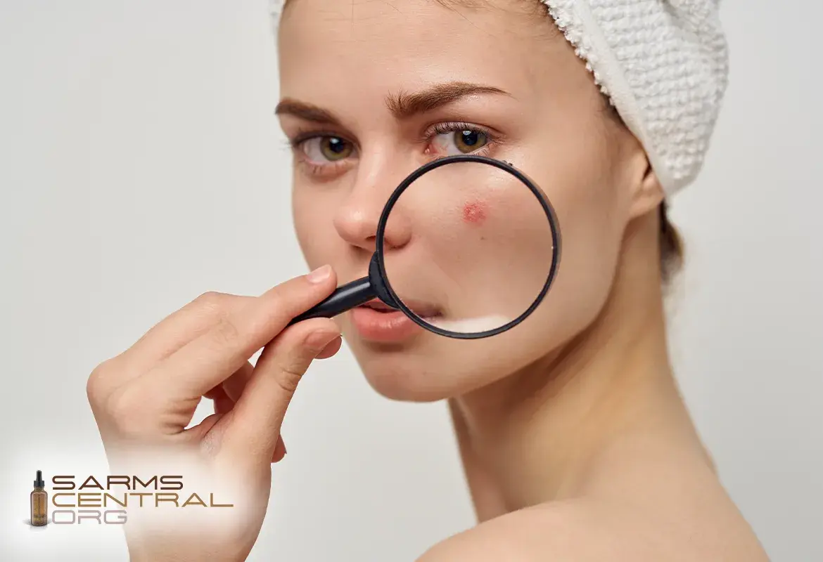 Do SARMs Cause Acne? Causes, Prevention and Clear Skin Tips